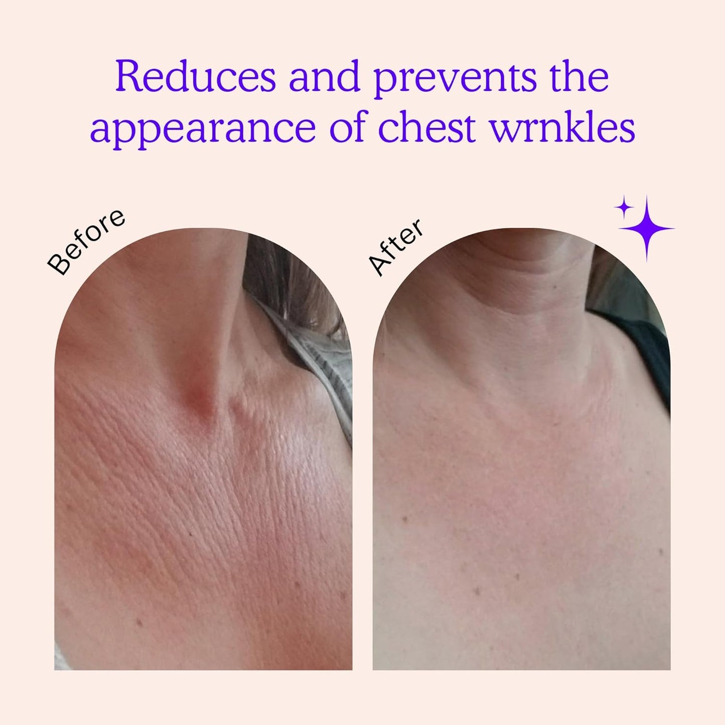 BLUMBODY Chest Wrinkle Pads – Anti-Wrinkle Silicone Patches Skin Firming, Smoothing – Reusable Overnight Chest Pad – Anti-Aging Crepe Erase Pads – Neck, Décolleté (1.5-Month Supply)