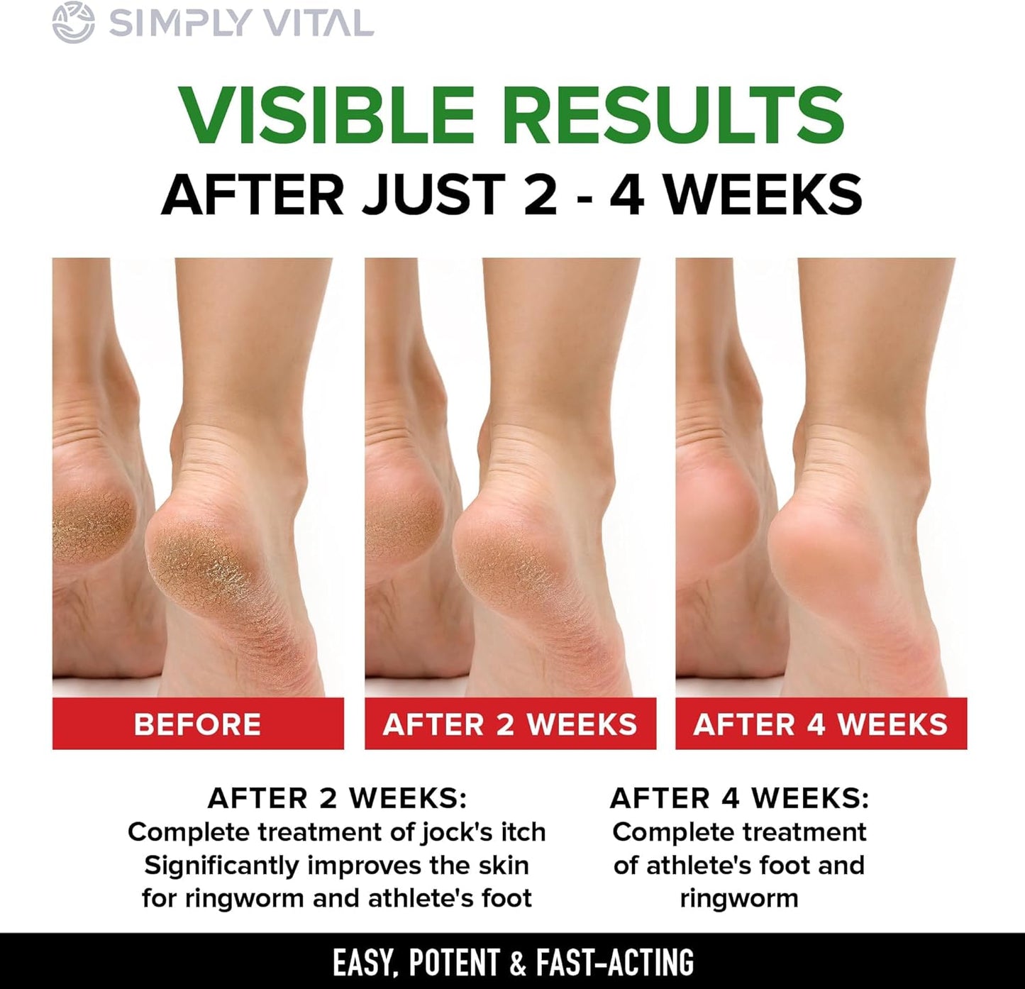 SimplyVital Antifungal Cream with Clotrimazole 1% - Foot Skin Fungus Treatment Extra Strength for Humans - Anti fungal Treatment for Ringworm, Jock Itch & Athlete’s Foot – Made in USA – 2 oz