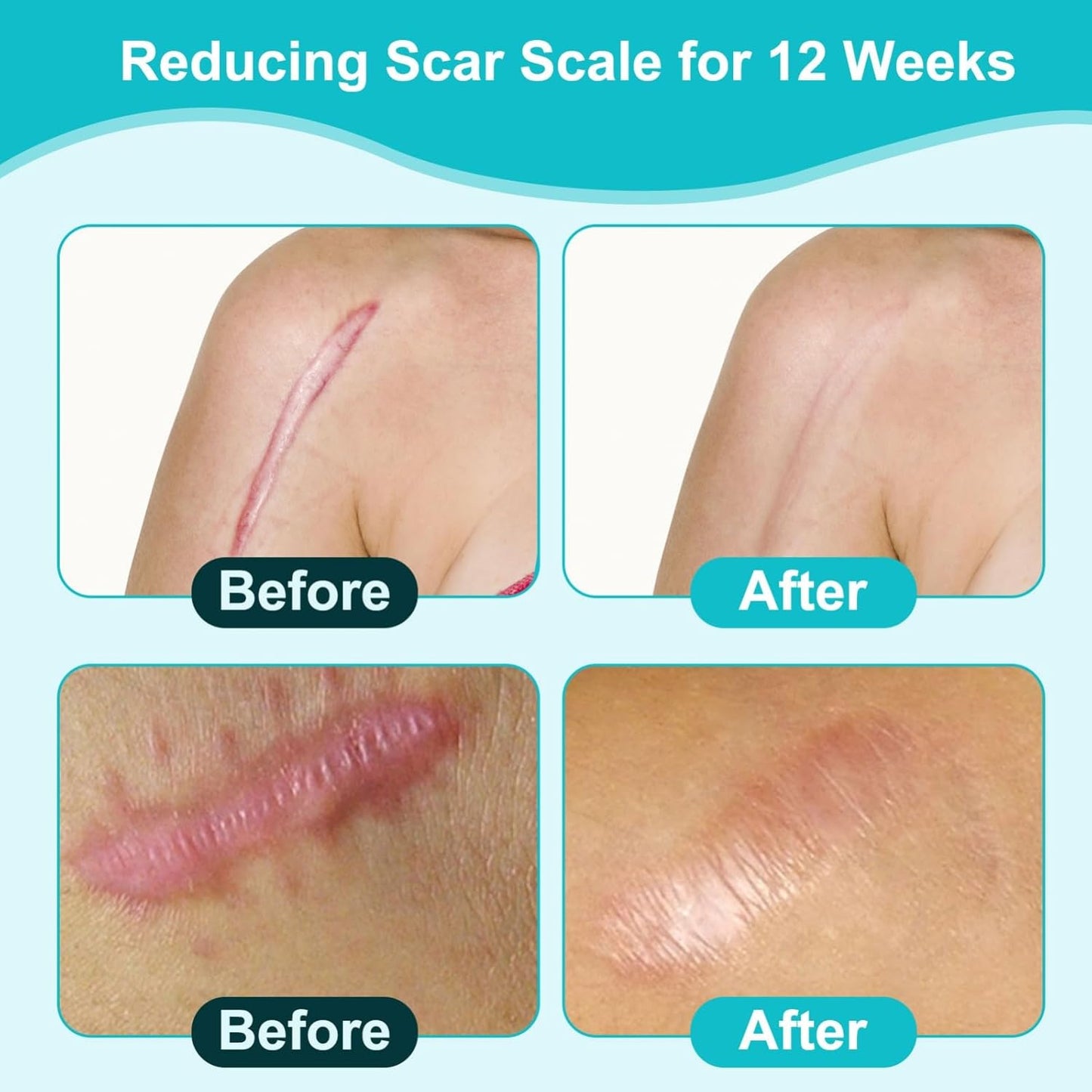 Hydrocolloid Bandages Roll 1.9” x 118”Inch, Hydrocolloid Roll Gel Bandages for Wounds, Large Hydrocolloid Patch with Self-Adhesive, Ultra Absorbent, Flexible & Waterproof, DIY Size & Shape