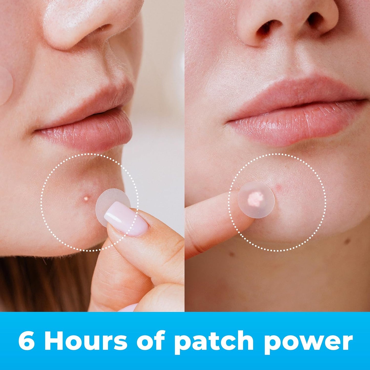 Pimple Patches for Face (120 Patches), Hydrocolloid Acne Patches with Tea Tree Oil, Pimple Patch Pimple Stickers - Hydrocolloid Patch Acne Dots - Acne Pimple Patches For Face - Zit Patches